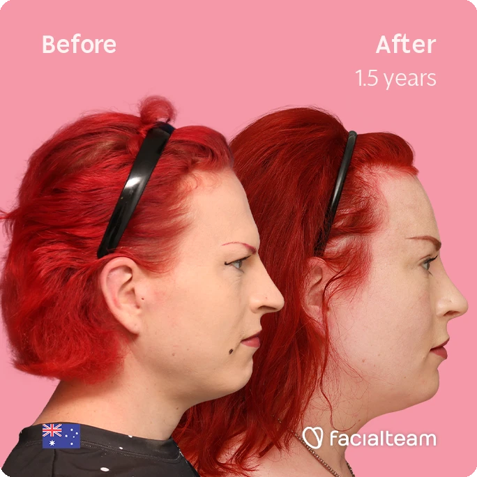 Side right square image of FFS patient Alexis showing the results before-after with Facialteam consisting of forehead and rhinoplasty feminization surgery.