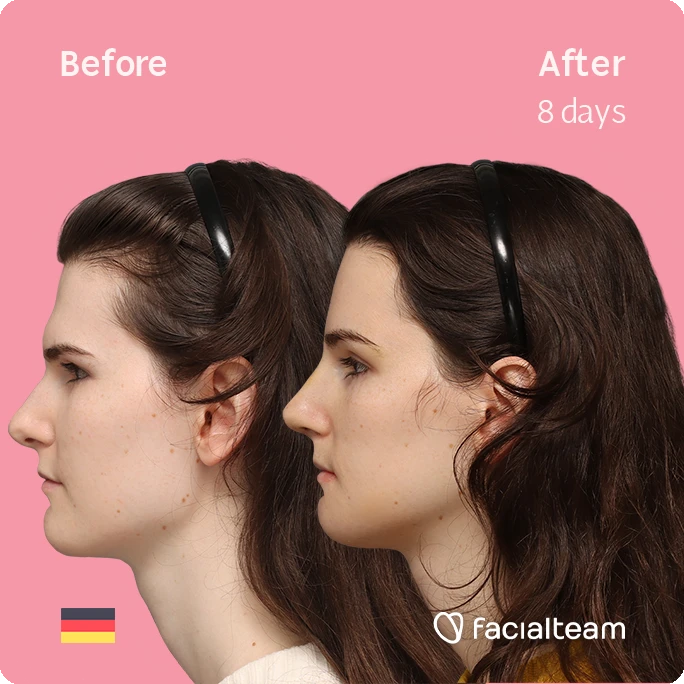 Side left square image of FFS patient Lena showing the results before-after with Facialteam consisting of forehead, rhinoplasty, chin and jaw feminization surgery.