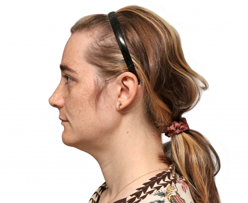 Side left profile photo of Isabelle B. after surgery.