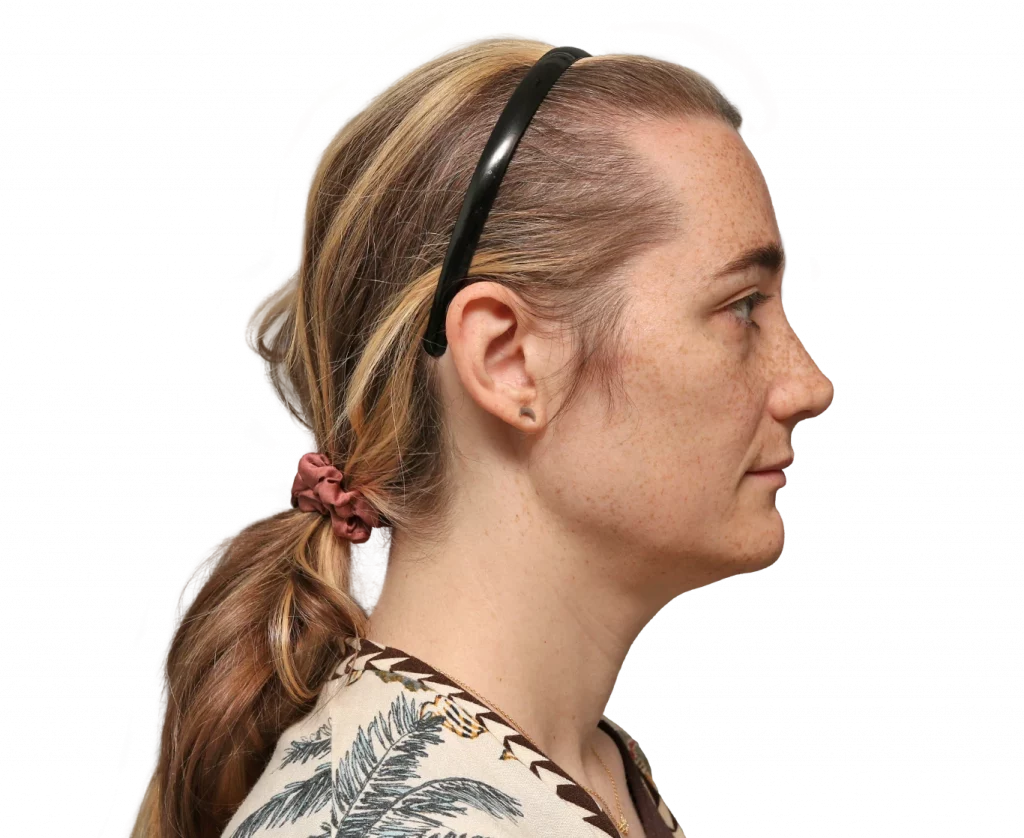 Side right profile photo of Isabelle B. after surgery.