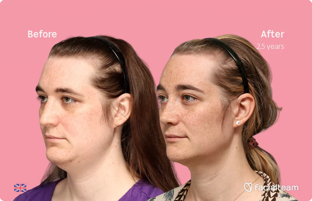 Side left image of FFS patient Isabelle showing the results before-after with Facialteam consisting of forehead, chin and rhinoplasty feminization surgery.
