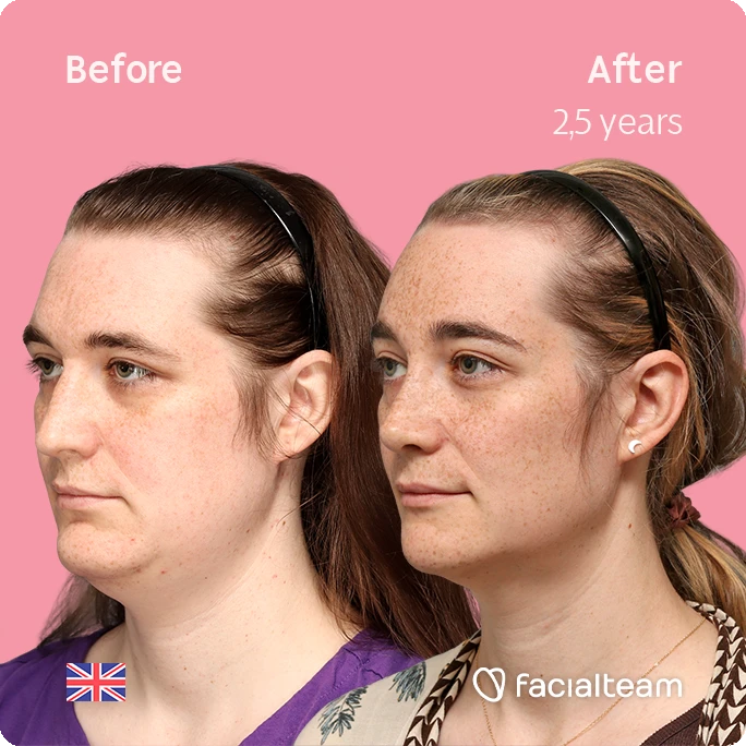 Side left square image of FFS patient Isabelle showing the results before-after with Facialteam consisting of forehead, chin and rhinoplasty feminization surgery.