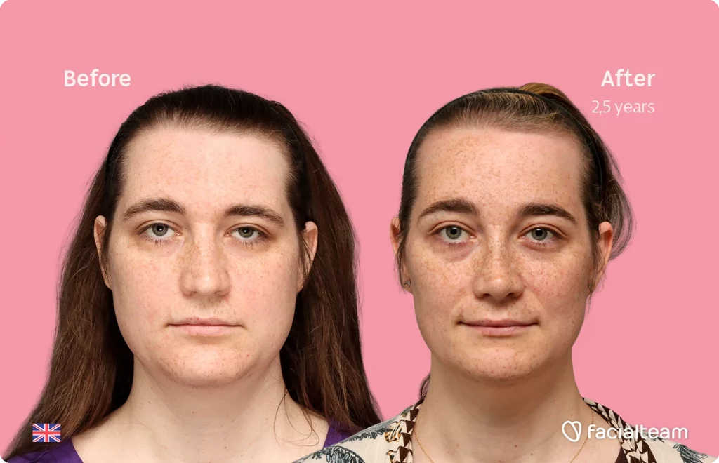 Frontal image of FFS patient Isabelle showing the results before-after with Facialteam consisting of forehead, chin and rhinoplasty feminization surgery.