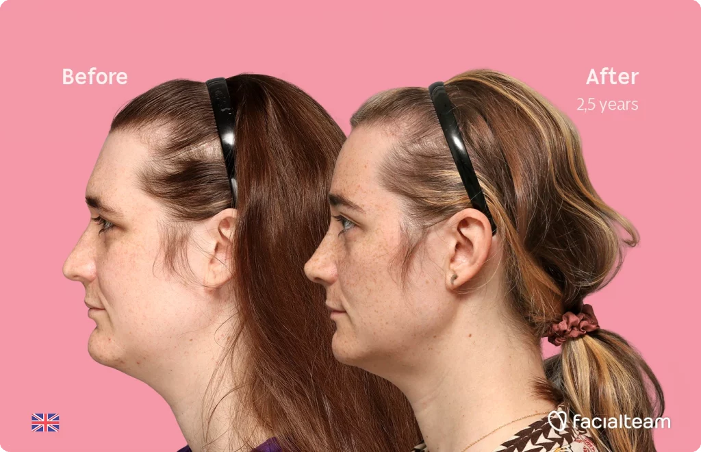 Side left image of FFS patient Isabelle showing the results before-after with Facialteam consisting of forehead, chin and rhinoplasty feminization surgery.