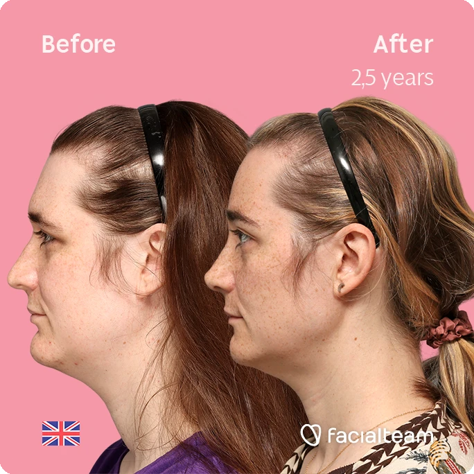Side left square image of FFS patient Isabelle showing the results before-after with Facialteam consisting of forehead, chin and rhinoplasty feminization surgery.