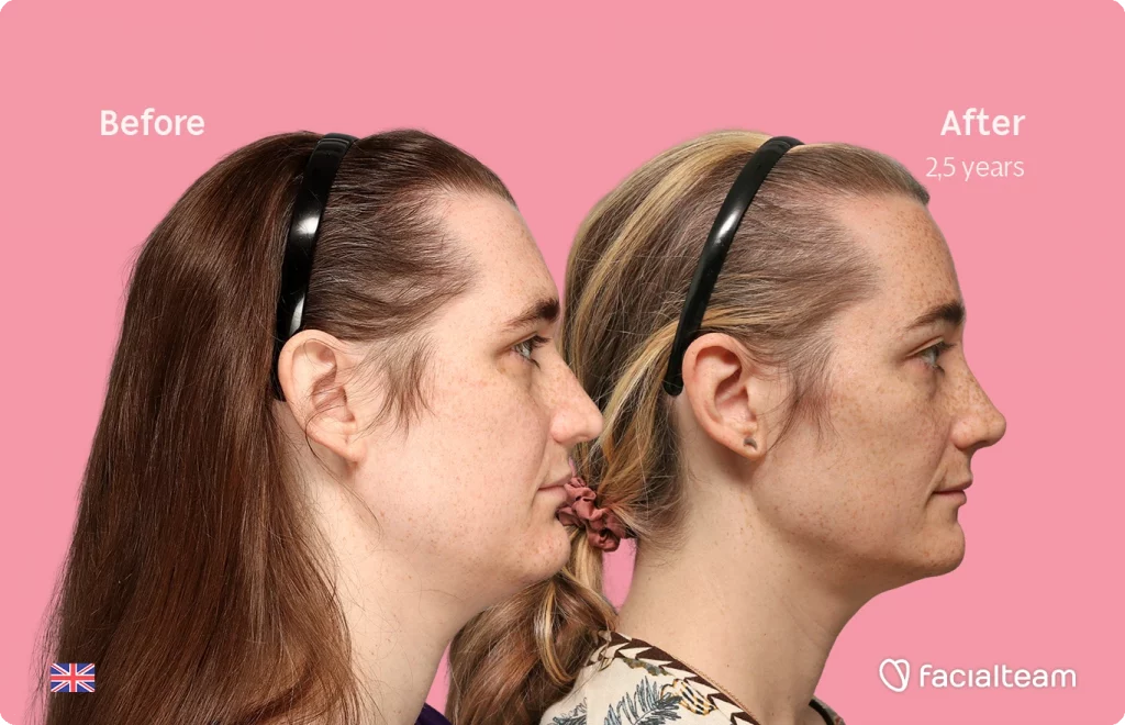 Side right square image of FFS patient Isabelle showing the results before-after with Facialteam consisting of forehead, chin and rhinoplasty feminization surgery.