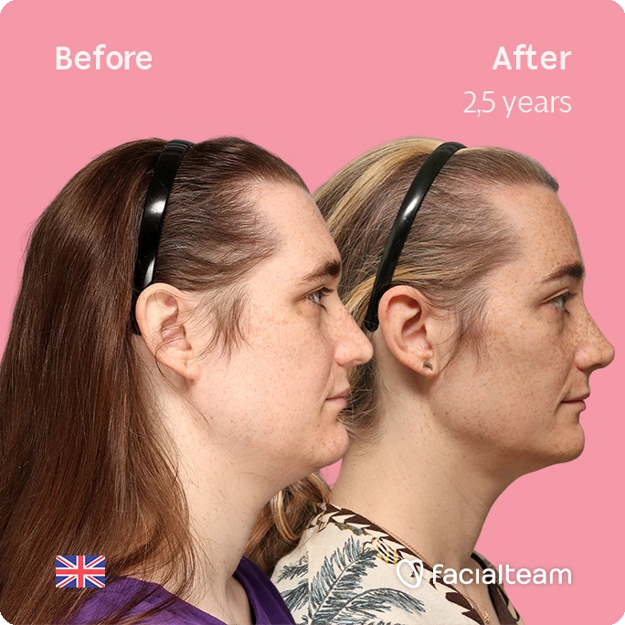 Side right square image of FFS patient Isabelle showing the results before-after with Facialteam consisting of forehead, chin and rhinoplasty feminization surgery.