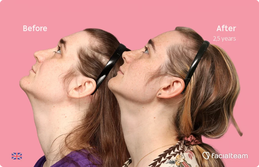 Side up left image of FFS patient Isabelle showing the results before-after with Facialteam consisting of forehead, chin and rhinoplasty feminization surgery.