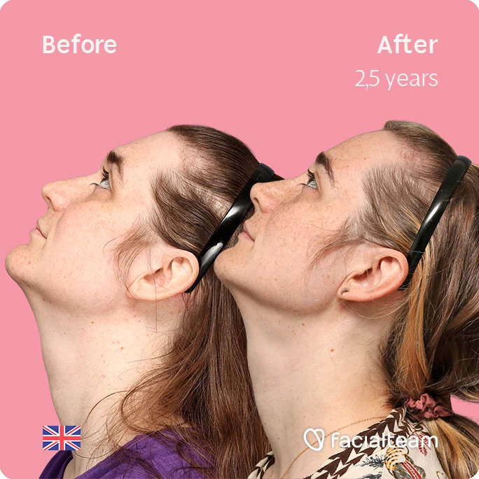 Side up left square image of FFS patient Isabelle showing the results before-after with Facialteam consisting of forehead, chin and rhinoplasty feminization surgery.