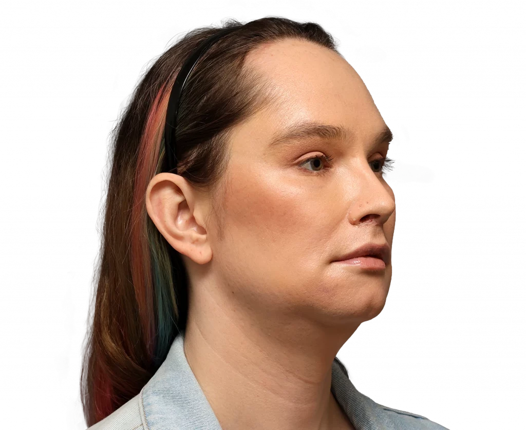 Angled right profile photo of Bryn after surgery.