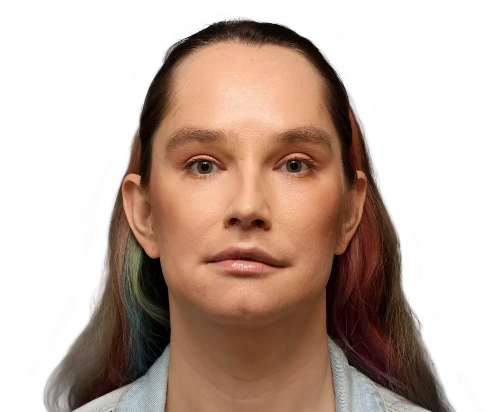 Frontal profile photo of Bryn after surgery.