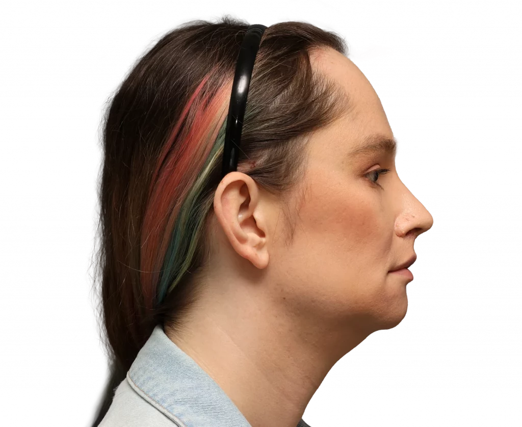 Side right profile photo of Bryn after surgery.