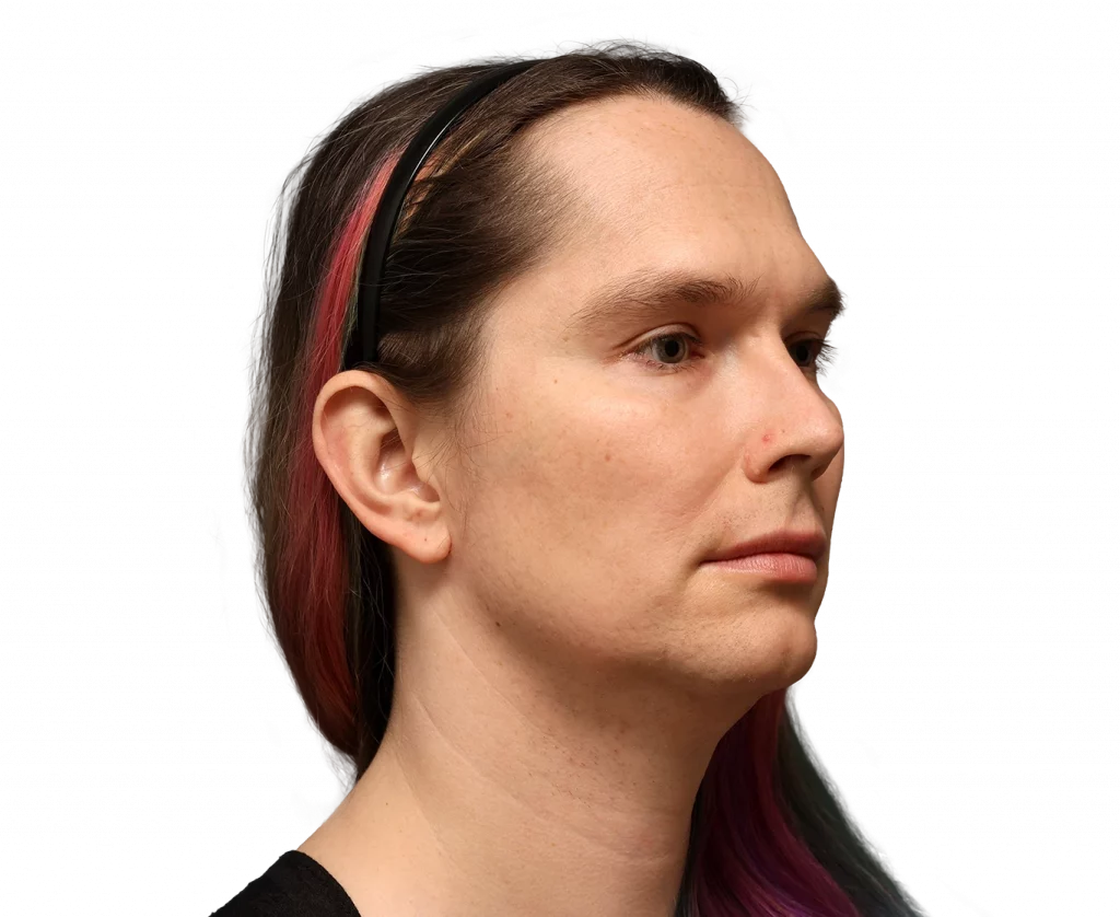 Angled right profile photo of Bryn before surgery.
