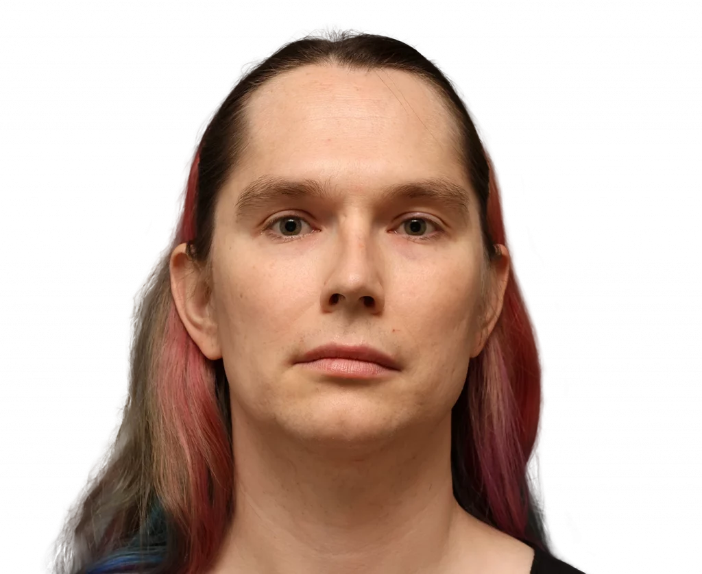 Frontal profile photo of Bryn before surgery.