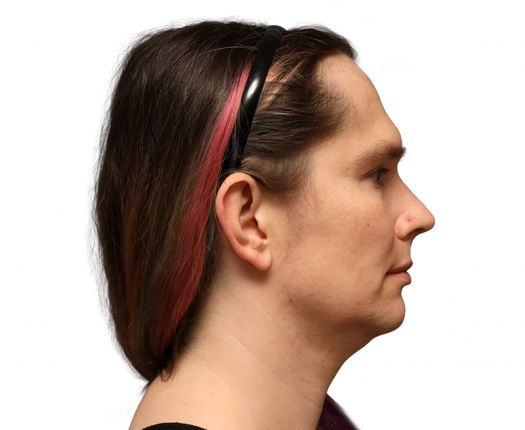 Side right profile photo of Bryn before surgery.