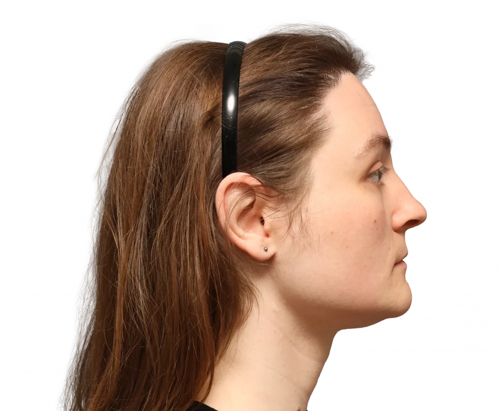 Side right profile photo of Gertrude after surgery.