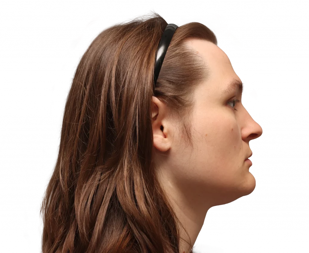 Side right profile photo of Gertrude before surgery.