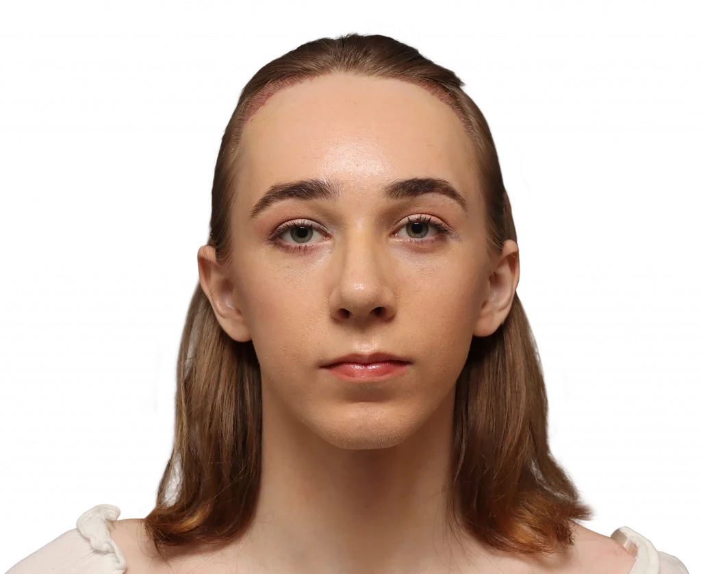 Frontal profile photo of Luca after surgery.