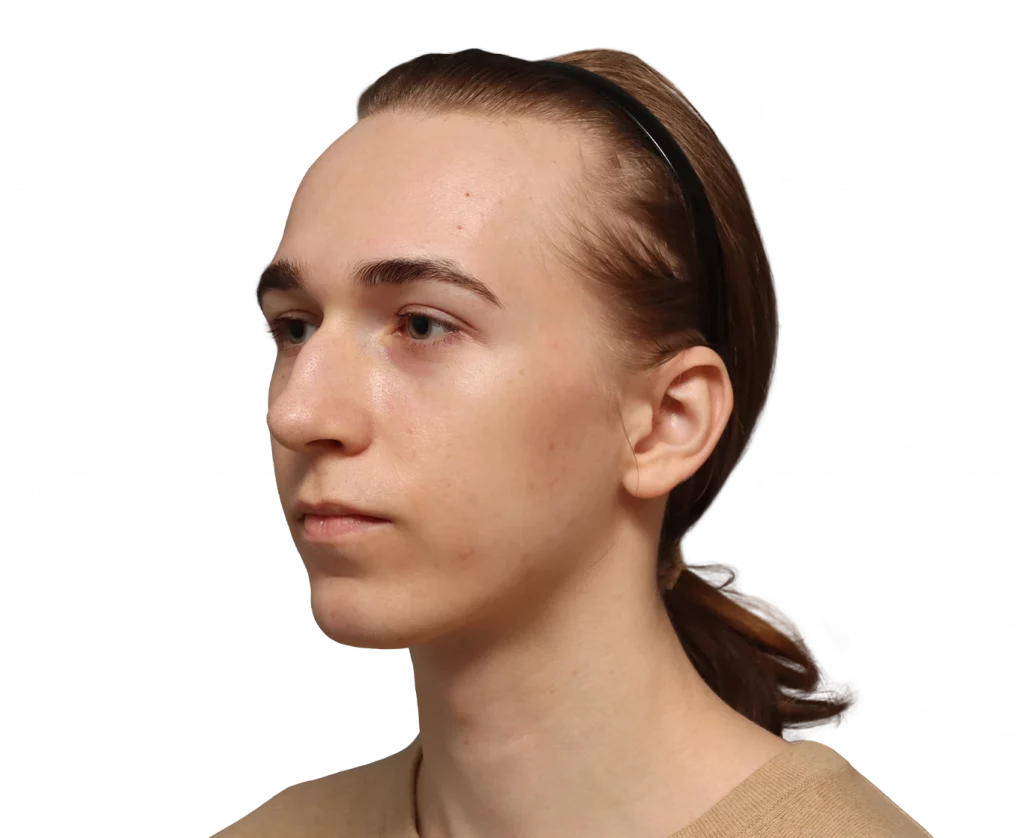Angled left profile photo of Luca before surgery.