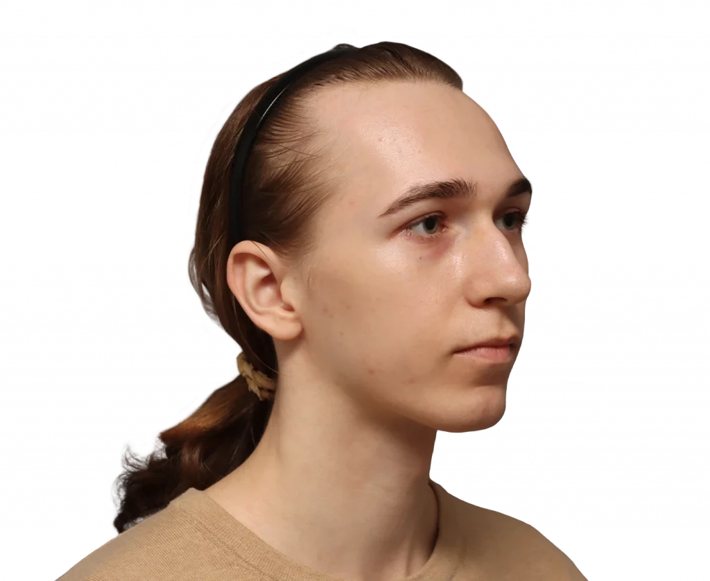 Angled right profile photo of Luca before surgery.