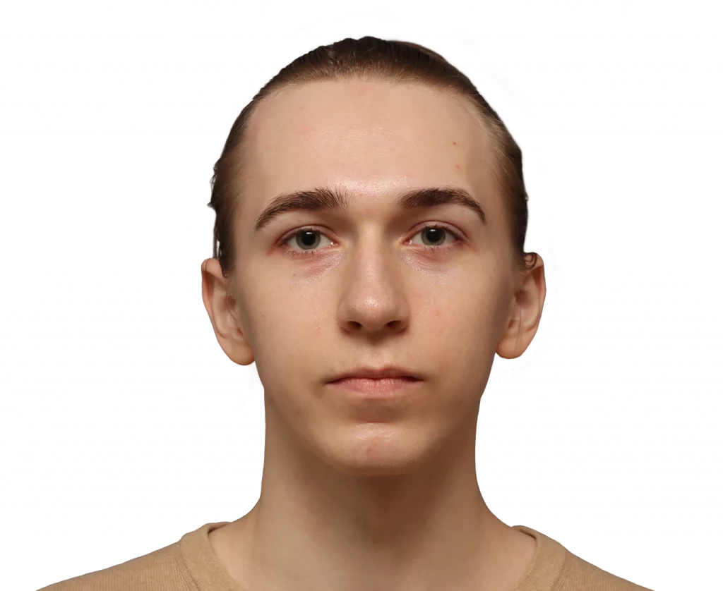 Frontal profile photo of Luca before surgery.
