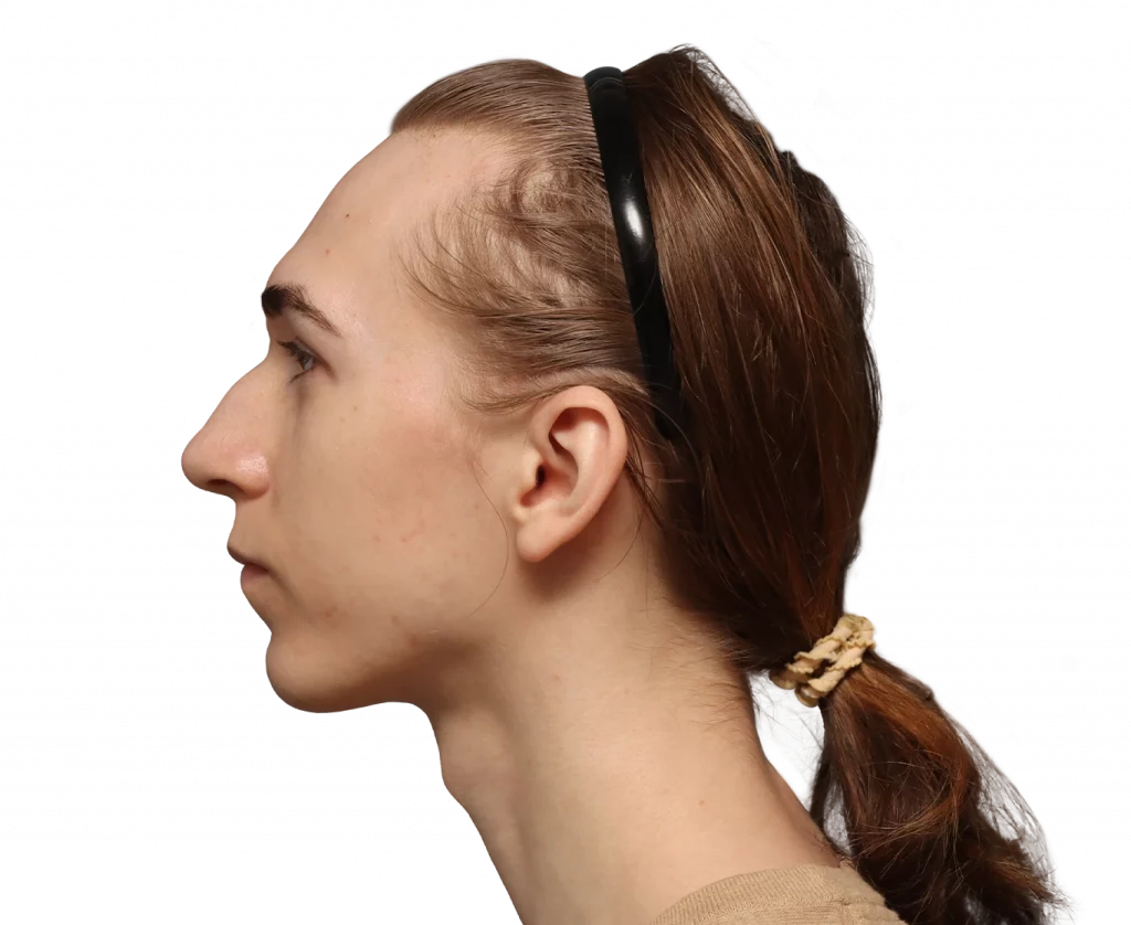 Side left profile photo of Luca before surgery.