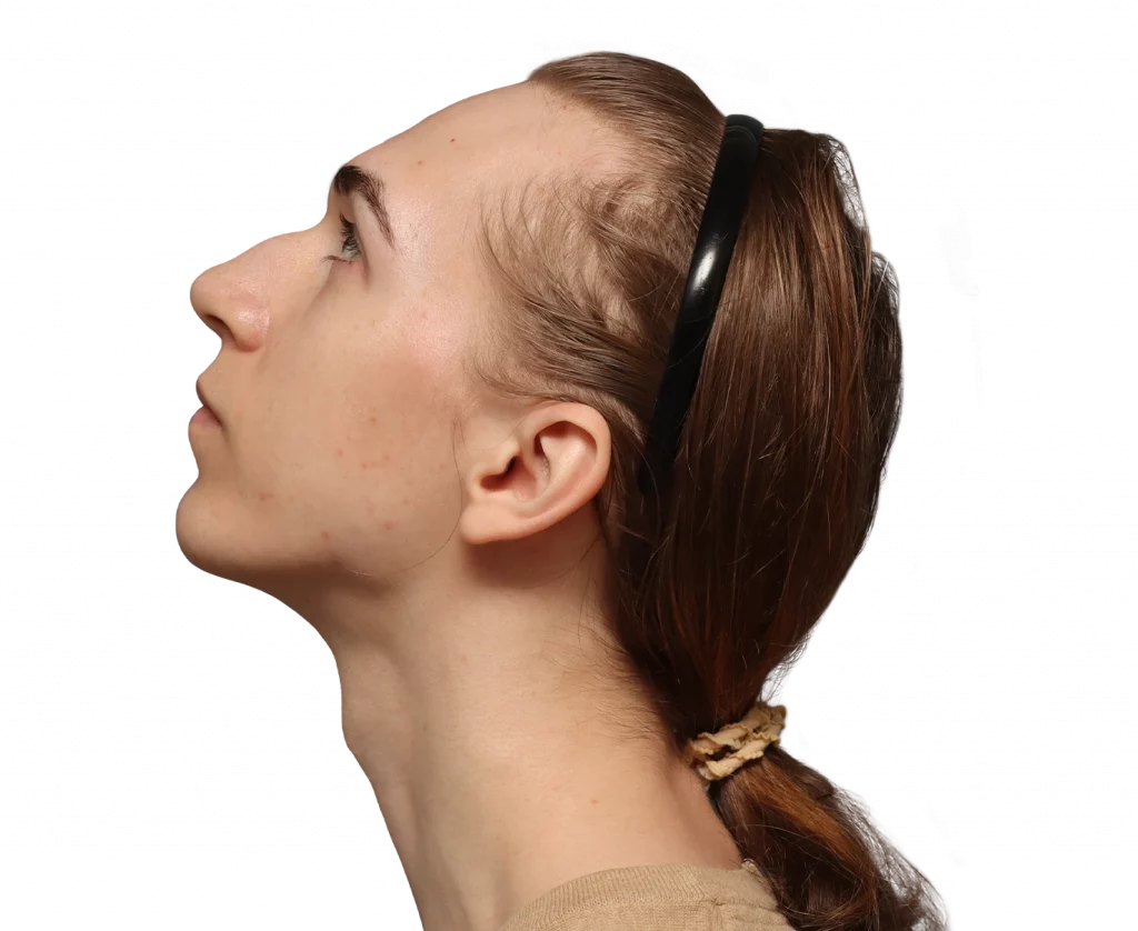 Angled left up profile photo of Luca before surgery.