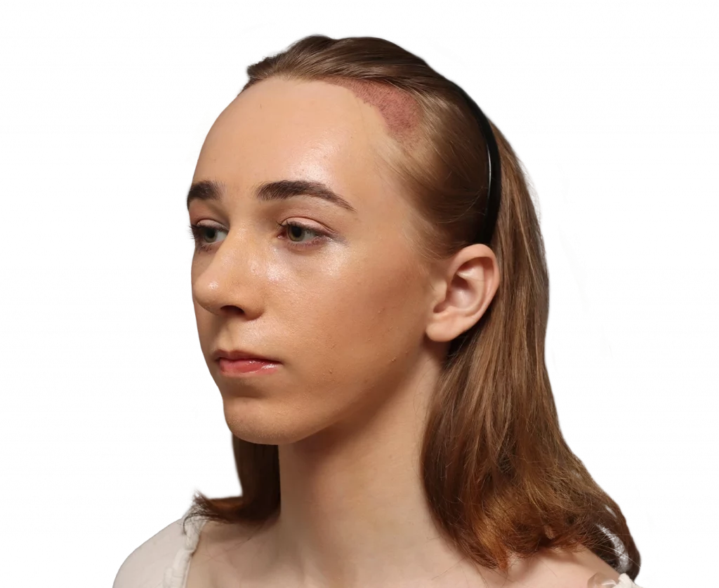 Angled left profile photo of Luca after surgery.
