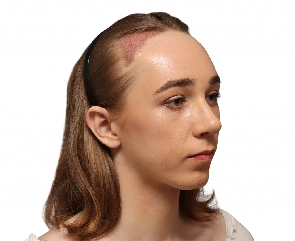Angled right profile photo of Luca after surgery.