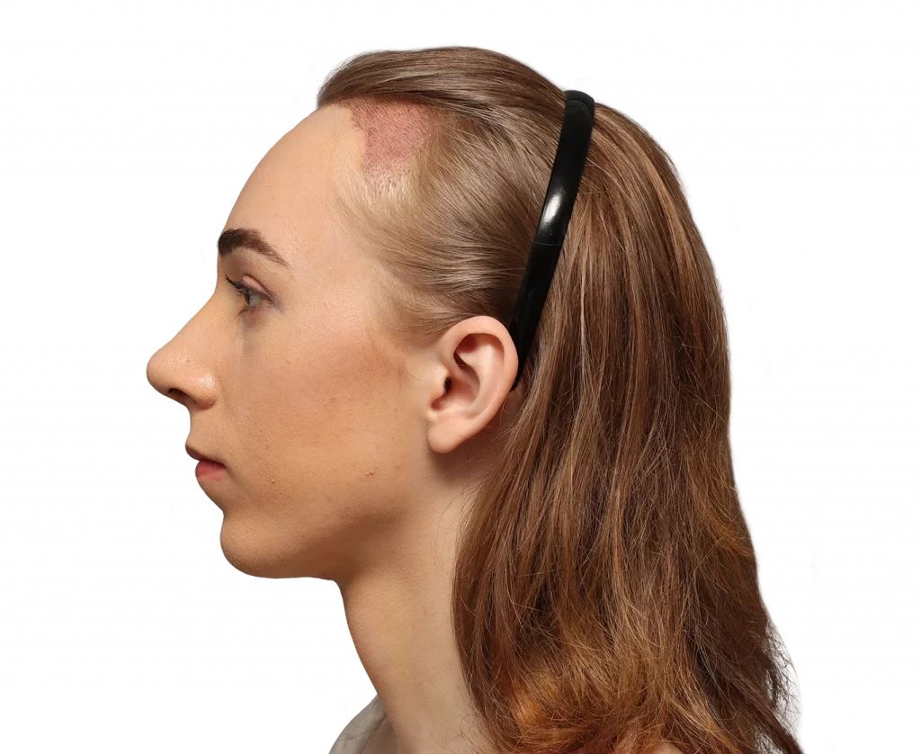 Side left profile photo of Luca after surgery.