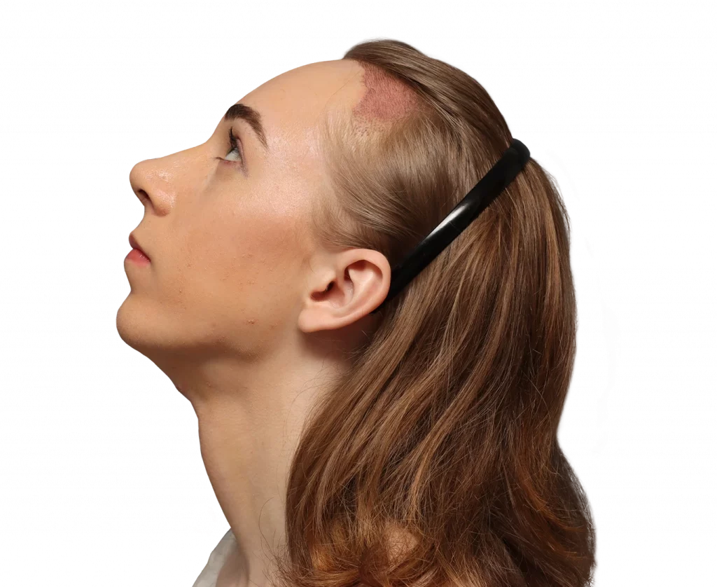 Side left up profile photo of Luca after surgery.