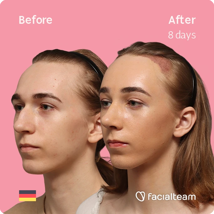 Angled left square image of FFS patient Luca F. showing the results before-after with Facialteam consisting of Forehead with Hair Transplant, Tracheal Shave and Nose Feminization surgery