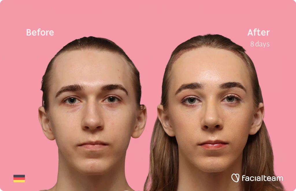 Frontal image of FFS patient Luca F. showing the results before-after with Facialteam consisting of Forehead with Hair Transplant, Tracheal Shave and Nose Feminization surgery