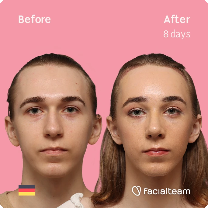 Frontal square image of FFS patient Luca F. showing the results before-after with Facialteam consisting of Forehead with Hair Transplant, Tracheal Shave and Nose Feminization surgery