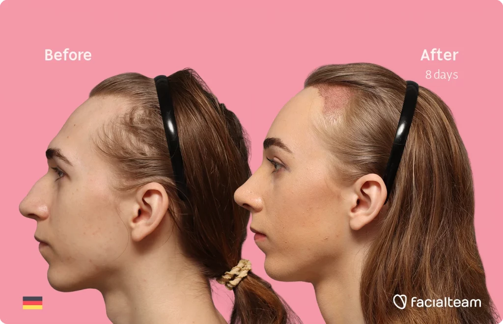Side left image of FFS patient Luca F. showing the results before-after with Facialteam consisting of Forehead with Hair Transplant, Tracheal Shave and Nose Feminization surgery