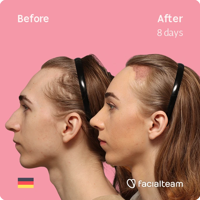 Side left square image of FFS patient Luca F. showing the results before-after with Facialteam consisting of Forehead with Hair Transplant, Tracheal Shave and Nose Feminization surgery