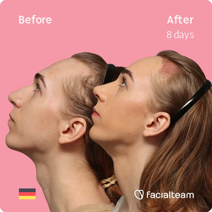Side left up square image of FFS patient Luca F. showing the results before-after with Facialteam consisting of Forehead with Hair Transplant, Tracheal Shave and Nose Feminization surgery