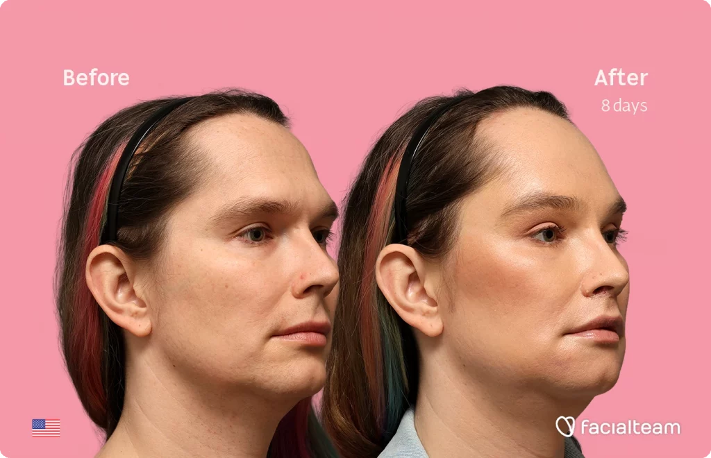 Angled right image of FFS patient Bryn P. showing the results before-after with Facialteam consisting of Forehead and Chin Feminization, and Lip Feminization, fat transfer in the upper lip and HIFU as complementary treatment