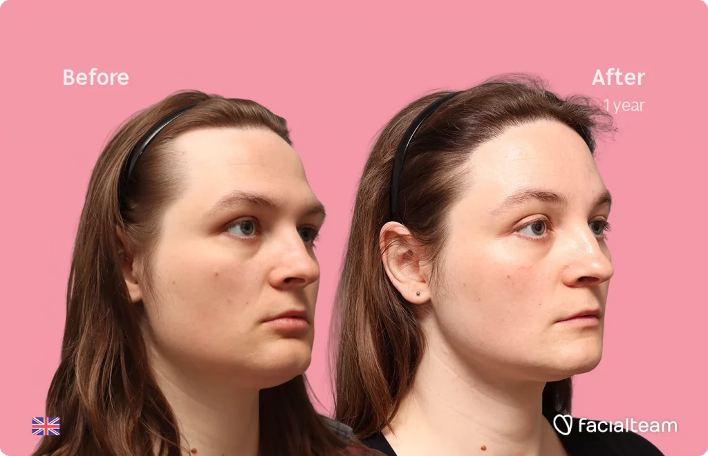 Angled right image of FFS patient Gertrude showing the results before-after with Facialteam consisting of Forehead with Hair Transplant, Jaw Feminization, Chin Feminization and HIFU as complementary treatment