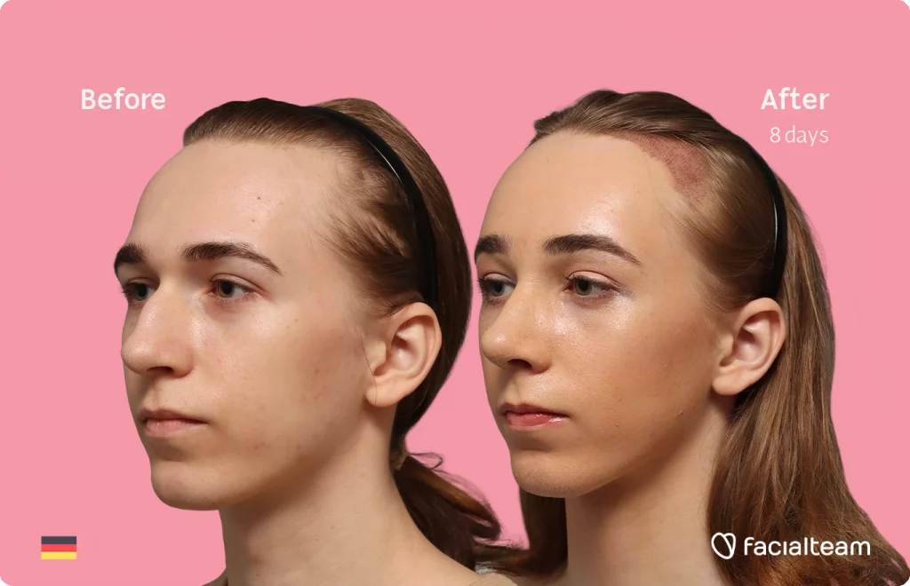 Angled left image of FFS patient Luca F. showing the results before-after with Facialteam consisting of Forehead with Hair Transplant, Tracheal Shave and Nose Feminization surgery