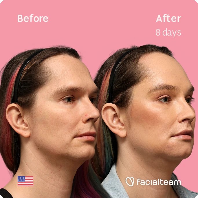 Angled right square image of FFS patient Bryn P. showing the results before-after with Facialteam consisting of Forehead and Chin Feminization, and Lip Feminization, fat transfer in the upper lip and HIFU as complementary treatment