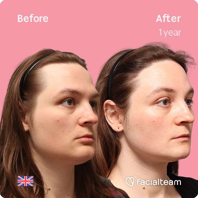 Angled right square image of FFS patient Gertrude showing the results before-after with Facialteam consisting of Forehead with Hair Transplant, Jaw Feminization, Chin Feminization and HIFU as complementary treatment