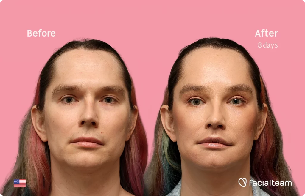 Frontal image of FFS patient Bryn P. showing the results before-after with Facialteam consisting of Forehead and Chin Feminization, and Lip Feminization, fat transfer in the upper lip and HIFU as complementary treatment