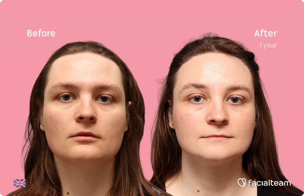Frontal image of FFS patient Gertrude showing the results before-after with Facialteam consisting of Forehead with Hair Transplant, Jaw Feminization, Chin Feminization and HIFU as complementary treatment