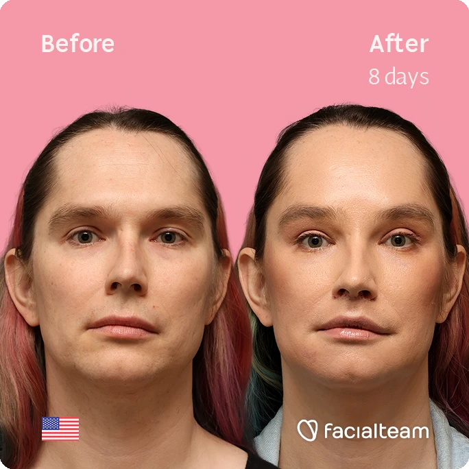 Frontal square image of FFS patient Bryn P. showing the results before-after with Facialteam consisting of Forehead and Chin Feminization, and Lip Feminization, fat transfer in the upper lip and HIFU as complementary treatment