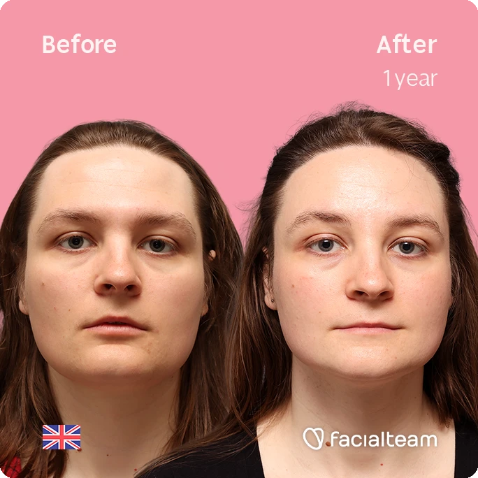Frontal square image of FFS patient Gertrude showing the results before-after with Facialteam consisting of Forehead with Hair Transplant, Jaw Feminization, Chin Feminization and HIFU as complementary treatment