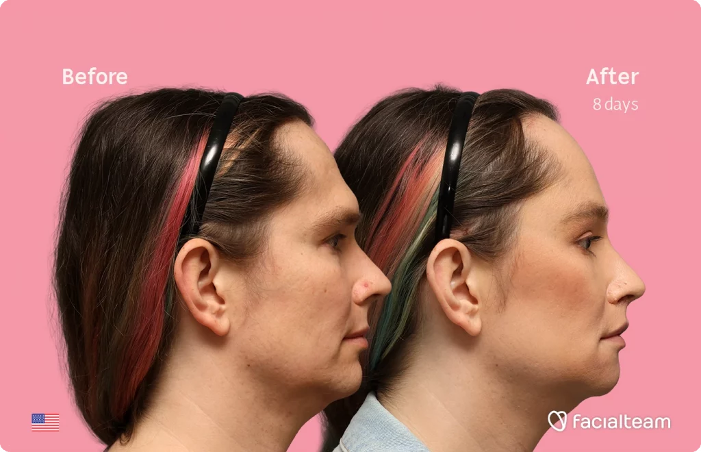 Side right image of FFS patient Bryn P. showing the results before-after with Facialteam consisting of Forehead and Chin Feminization, and Lip Feminization, fat transfer in the upper lip and HIFU as complementary treatment