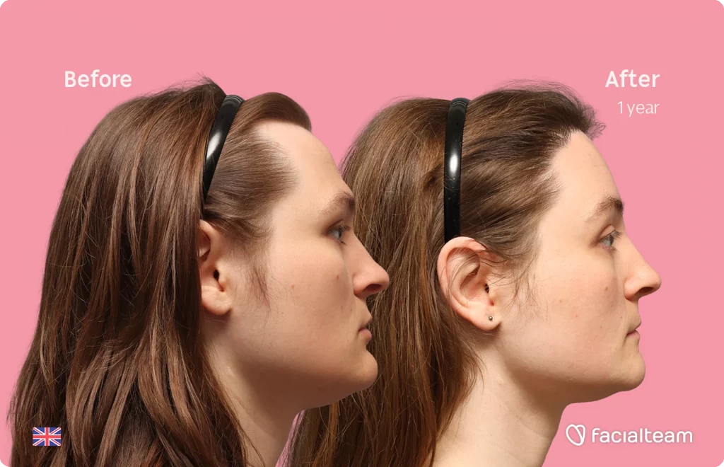 Side right image of FFS patient Gertrude showing the results before-after with Facialteam consisting of Forehead with Hair Transplant, Jaw Feminization, Chin Feminization and HIFU as complementary treatment