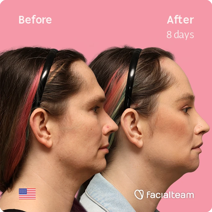 Side right square image of FFS patient Bryn P. showing the results before-after with Facialteam consisting of Forehead and Chin Feminization, and Lip Feminization, fat transfer in the upper lip and HIFU as complementary treatment