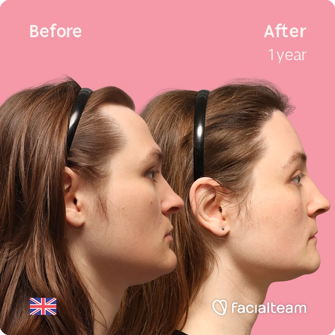 Side right square image of FFS patient Gertrude showing the results before-after with Facialteam consisting of Forehead with Hair Transplant, Jaw Feminization, Chin Feminization and HIFU as complementary treatment